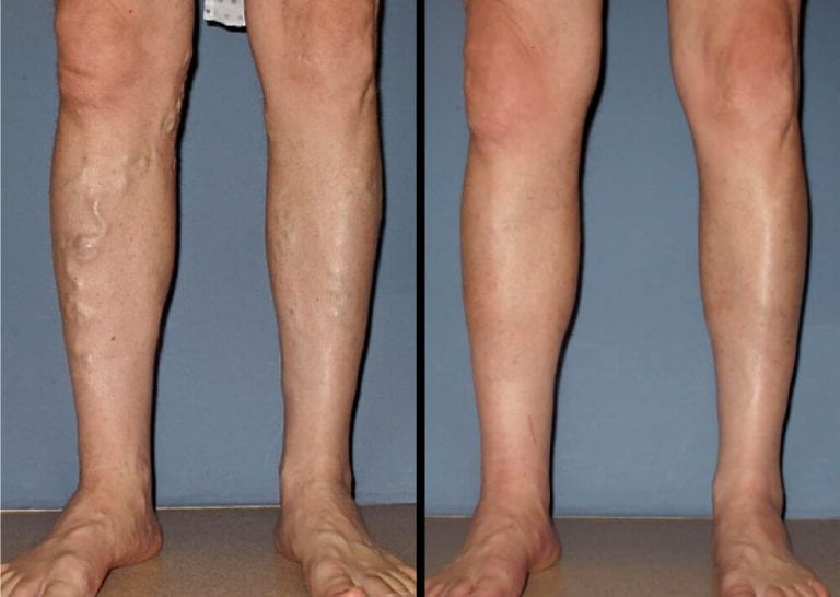 Before & After | Vein Treatment Madison & Jackson | MS Vein Institute